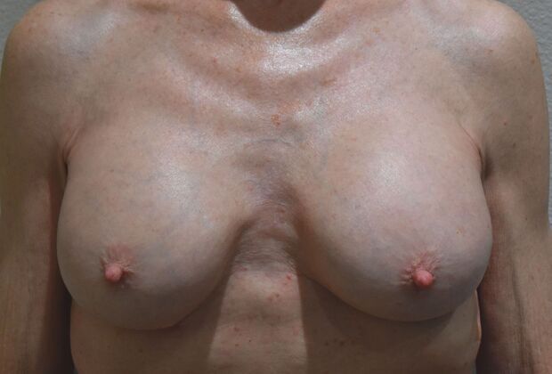 Breast Revision: Case 274 - After