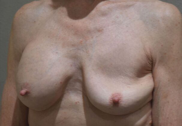 Breast Revision: Case 274 - Before