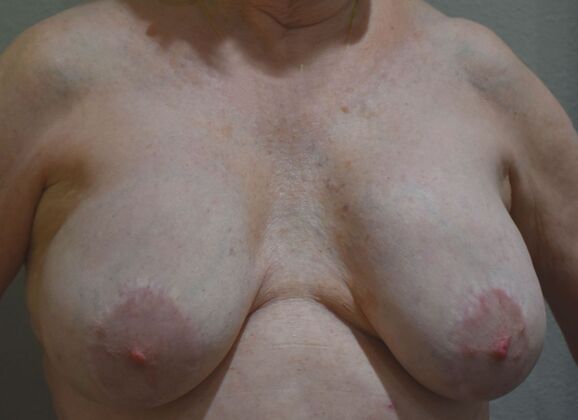 Breast Implant Removal: Case 47 - Before