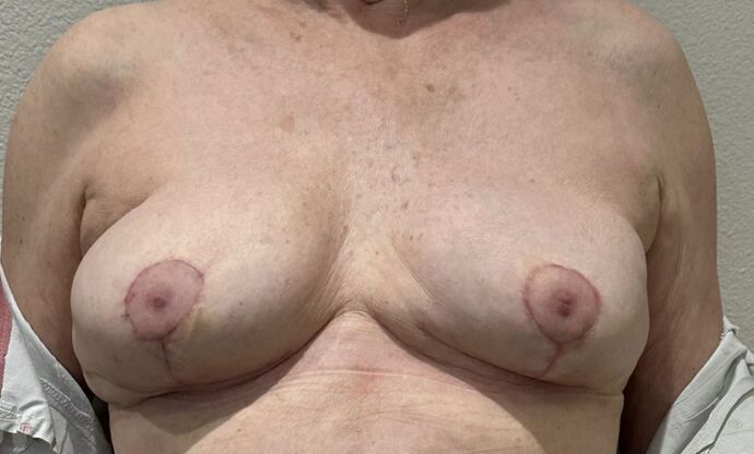 Breast Implant Removal Case 47 - After