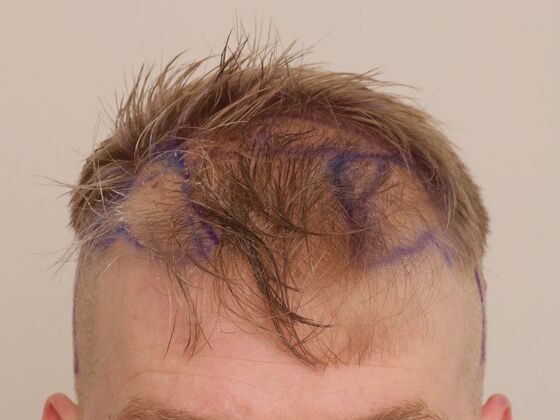 Male Before And After Hair Transplant Photos Hairline FUE (19) - Before