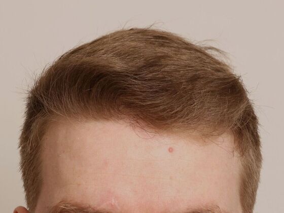 Male Before And After Hair Transplant Photos Hairline FUE (19) - After