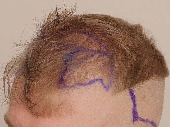 Hair Transplant - Male: Hairline FUE - Case 19 - Before FUE hair transplant