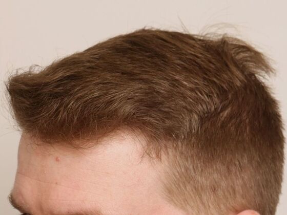 Hair Transplant - Male: Hairline FUE - Case 19 - After male FUE hair transplant
