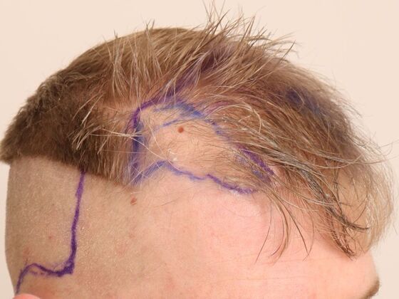 Hair Transplant - Male: Hairline FUE - Case 19 - Before FUE hair transplant