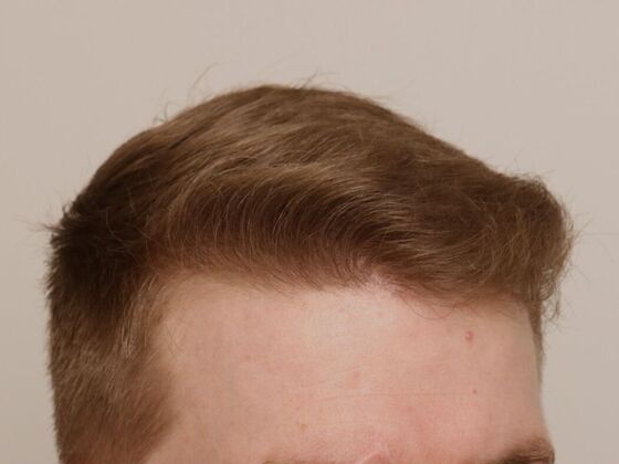 Hair Transplant - Male: Hairline FUE - Case 19 - After male FUE hair transplant
