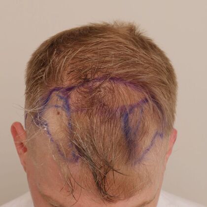 Hair Transplant - Male: Hairline FUE - Case 19 - Before FUE hair transplant