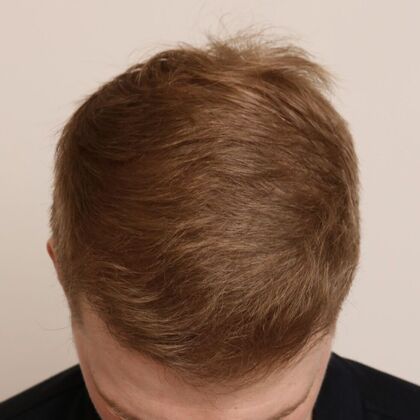 Hair Transplant - Male: Hairline FUE - Case 19 - After male FUE hair transplant
