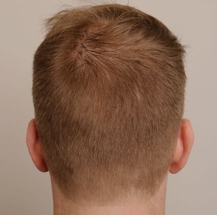 Hair Transplant - Male: Hairline FUE - Case 19 - After male FUE hair transplant