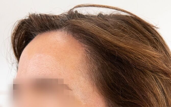 FUT Female Case 9 - After