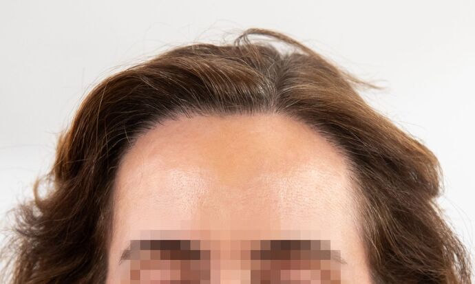 FUT Female: Case 9 - After