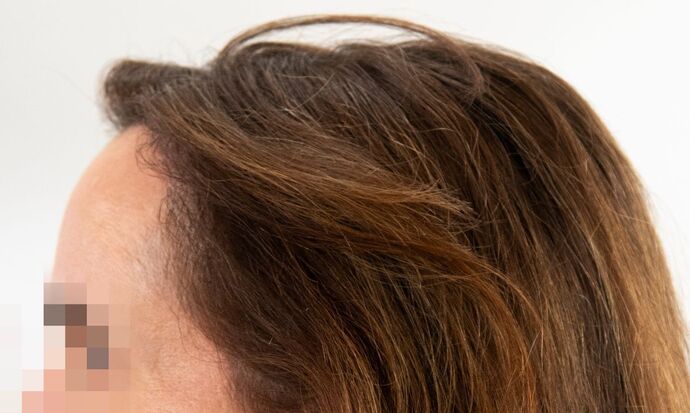 FUT Female: Case 9 - After