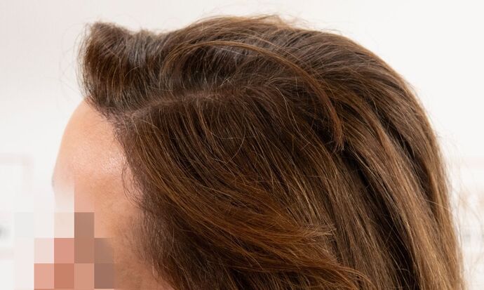 FUT Female: Case 9 - After