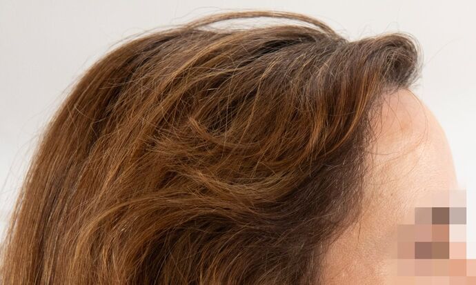 FUT Female: Case 9 - After