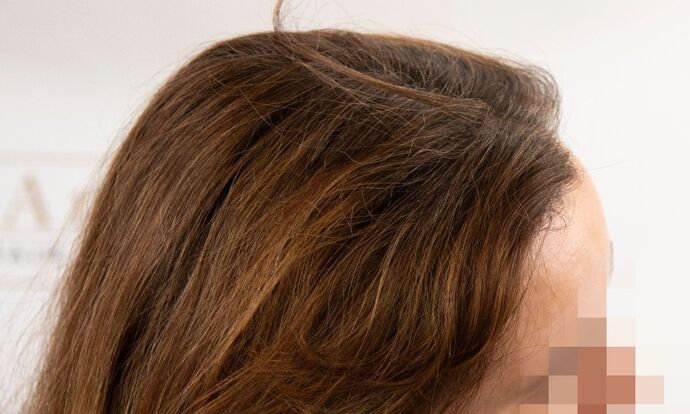 FUT Female: Case 9 - After