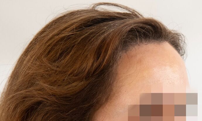 FUT Female: Case 9 - After