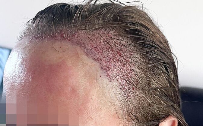 FUT Female Case 9 - Before