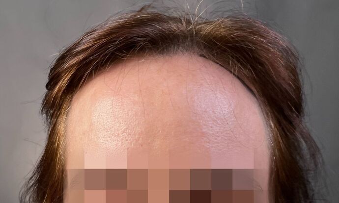 FUT Female: Case 9 - Before