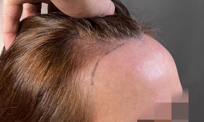 FUT Female: Case 9 - Before