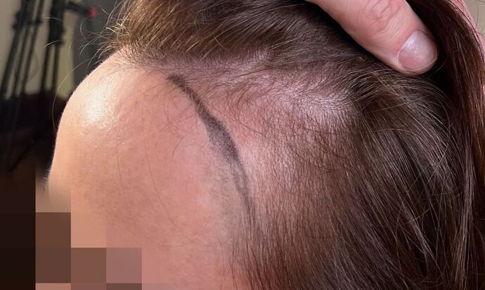 FUT Female: Case 9 - Before