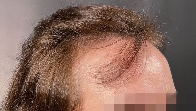 FUT Female: Case 9 - Before