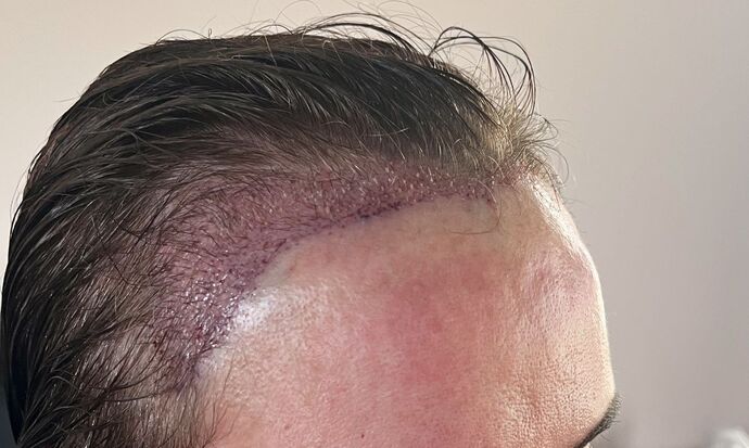 FUT Female: Case 9 - Before