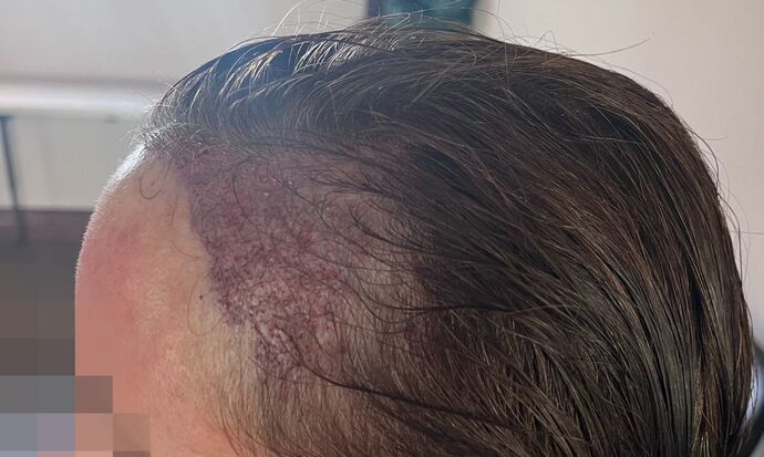 FUT Female: Case 9 - Before