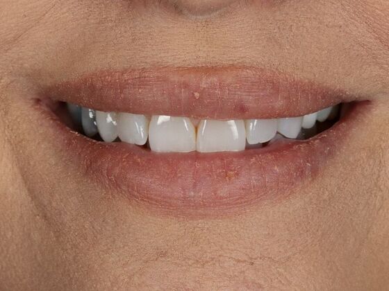 Porcelain Veneers: Natalie - Before