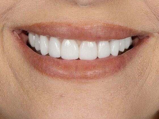 Porcelain Veneers: Natalie - After