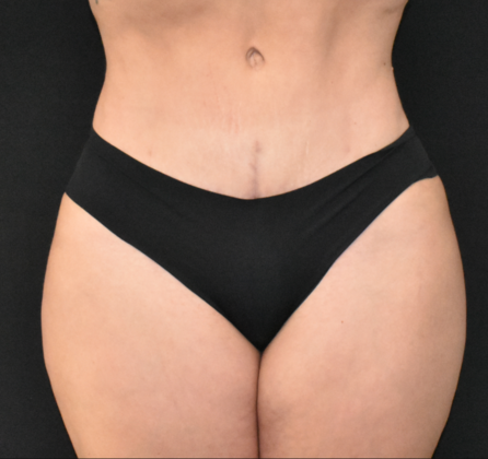 Abdominoplasty Case 23 - After