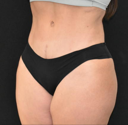 Abdominoplasty: Case 23 - After