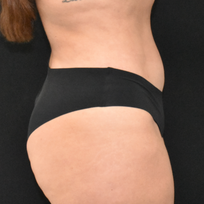 Abdominoplasty: Case 23 - After