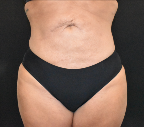Abdominoplasty Case 23 - Before