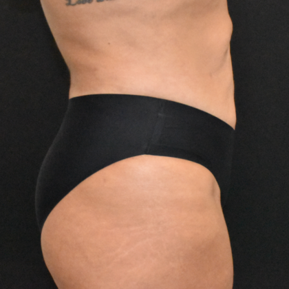 Abdominoplasty: Case 23 - Before