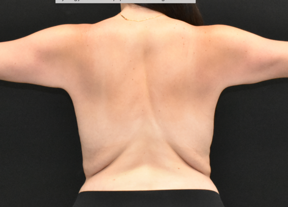 Torsoplasty: Case 4 - Before