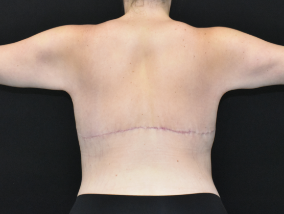 Torsoplasty: Case 4 - After