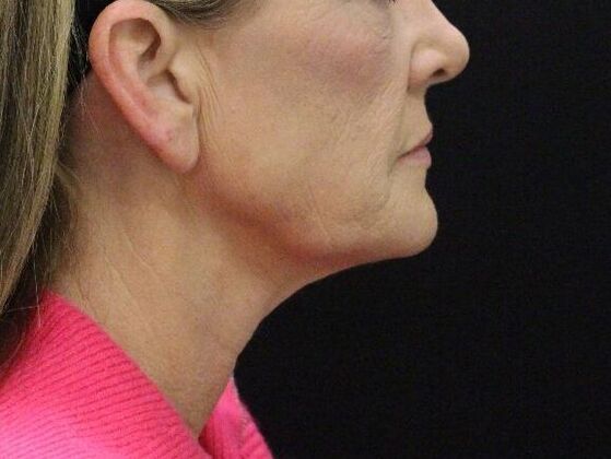 Face & Neck Lifts: Case 4 - Before