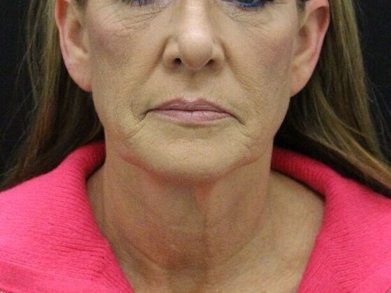 Face & Neck Lifts: Case 4 - Before
