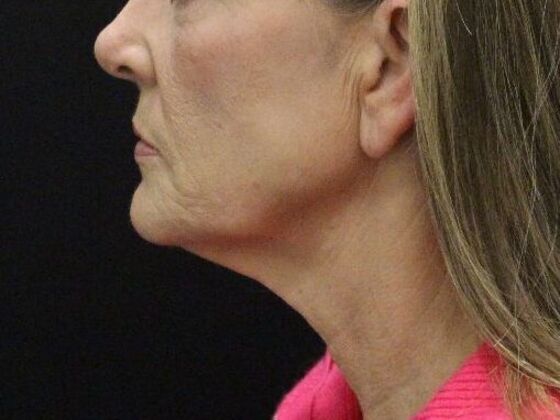 Face & Neck Lifts: Case 4 - Before