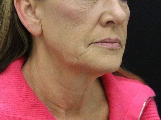 Face & Neck Lifts Case 4 - Before