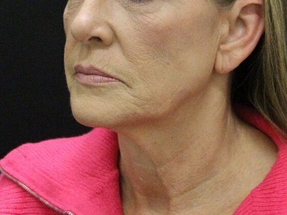 Face & Neck Lifts: Case 4 - Before