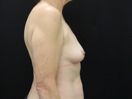 Breast Augmentation: Case 42 - Before