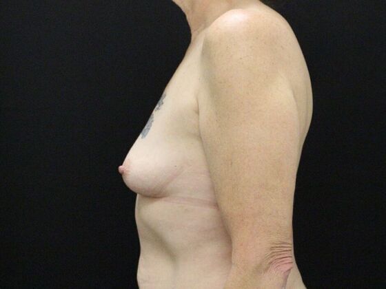 Breast Augmentation: Case 42 - Before