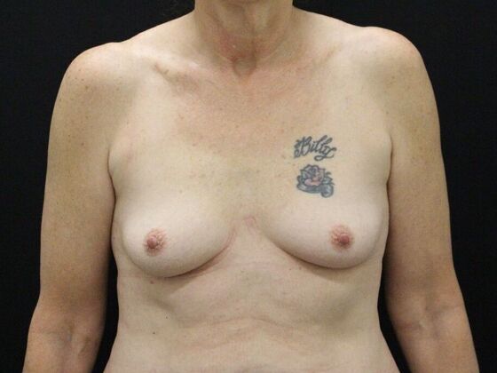 Breast Augmentation Case 42 - Before