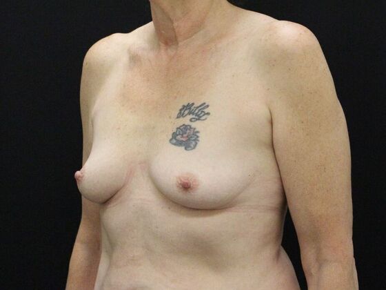 Breast Augmentation: Case 42 - Before
