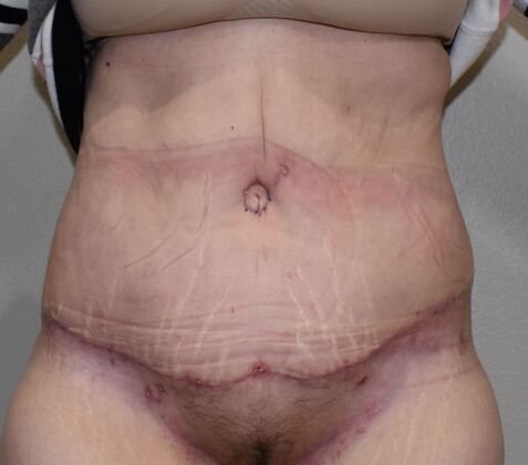 Tummy Tuck (Abdominoplasty): Case 9 - After
