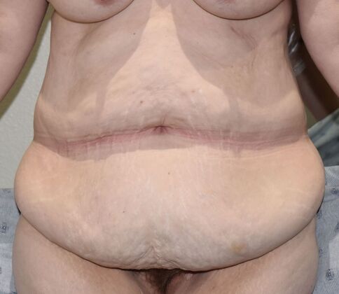 Tummy Tuck (Abdominoplasty): Case 9 - Before