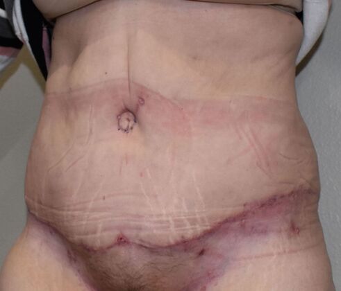 Tummy Tuck (Abdominoplasty): Case 9 - After
