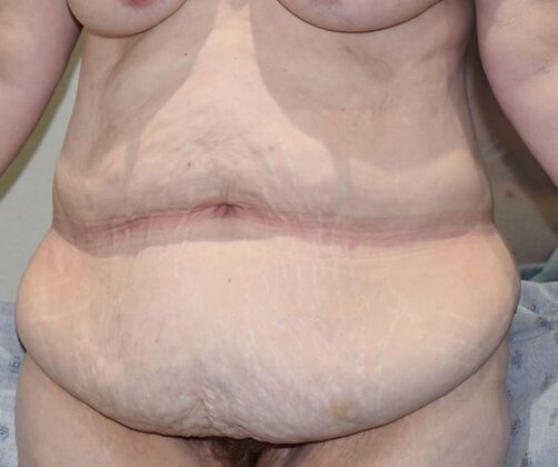 Massive Weight Loss : Case 167 - Before