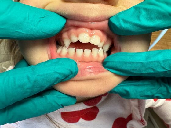 Invisalign Case 9 - Before